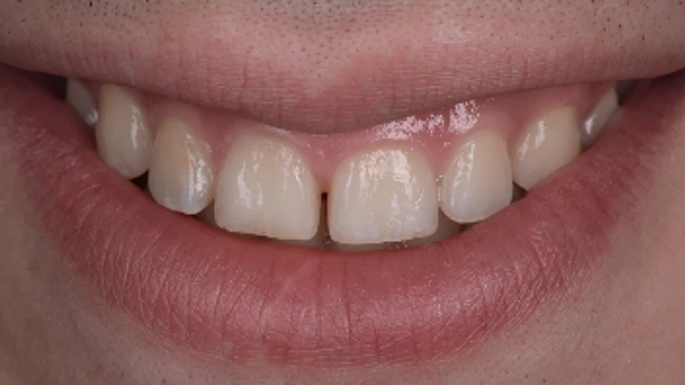 Estètica dental · Abans