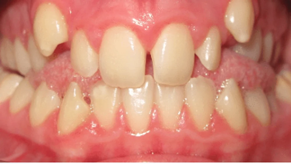 Invisalign · Abans
