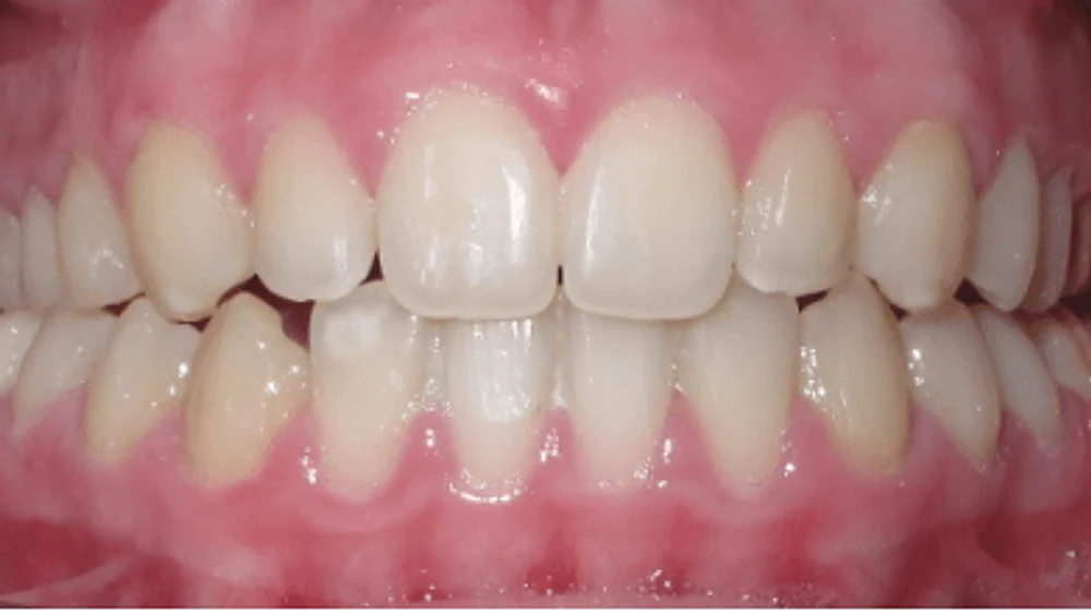 Invisalign · Després
