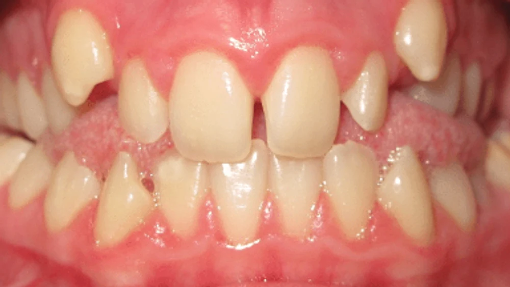 Invisalign Teen · Abans