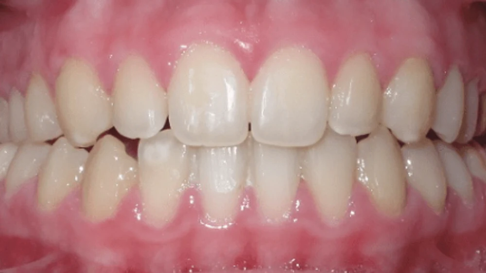 Invisalign Teen · Després